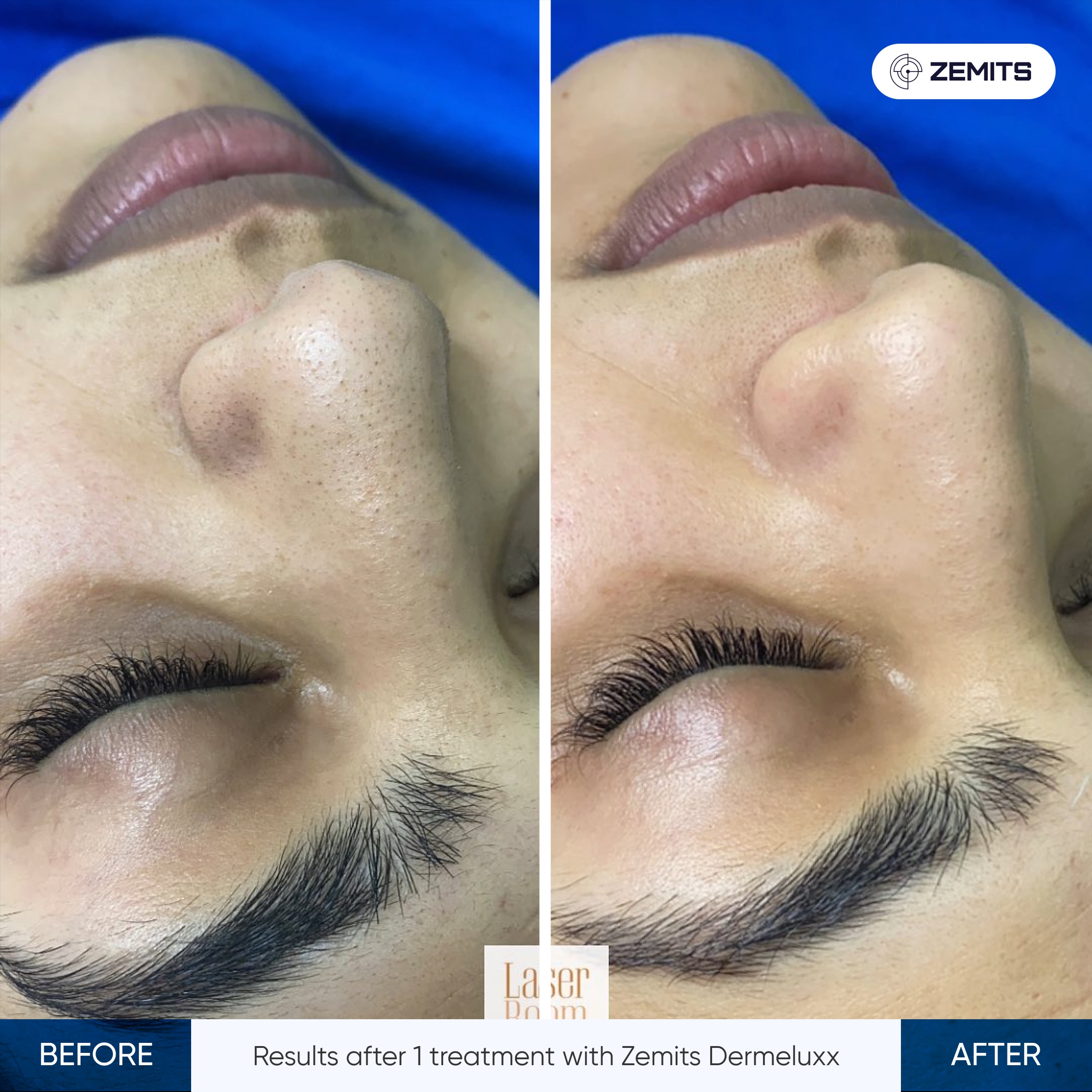 HydroDiamond Express at Allure Aesthetics & Beauty Co in Oregon, IL