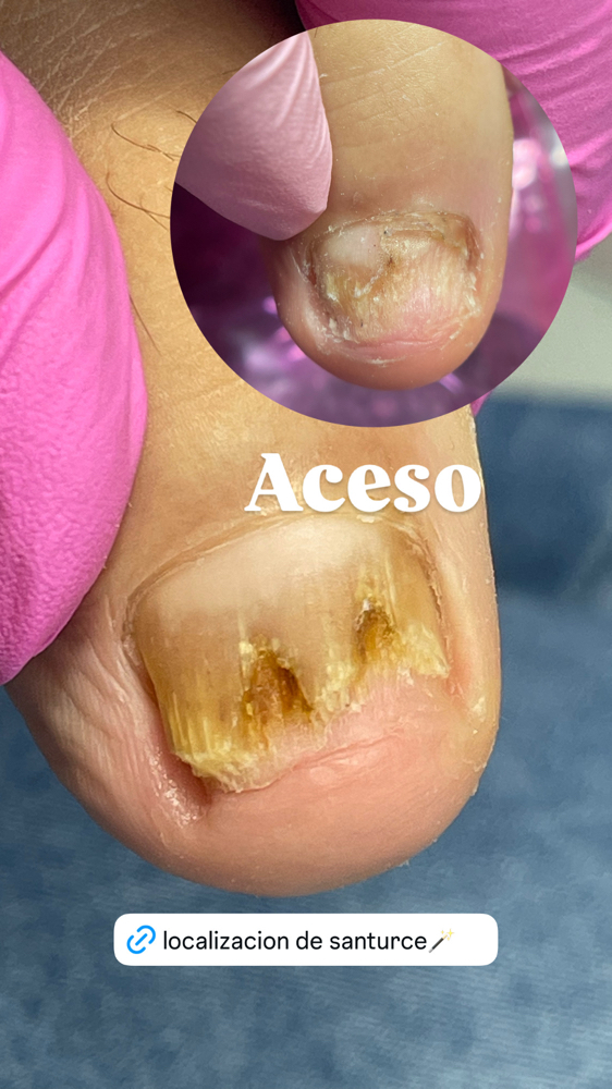 Tratamiento Para Hongo Con Kit