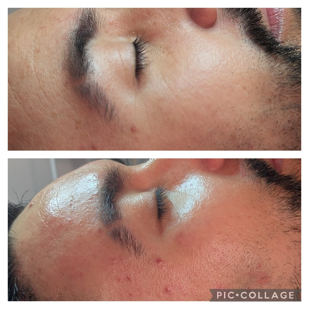 Hydrafacial - Oxygenation Treatment at Nenusk Aesthetics in Long Island City, NY