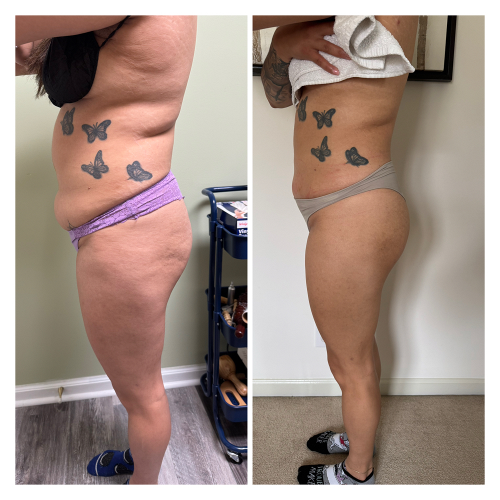 Body Sculpting