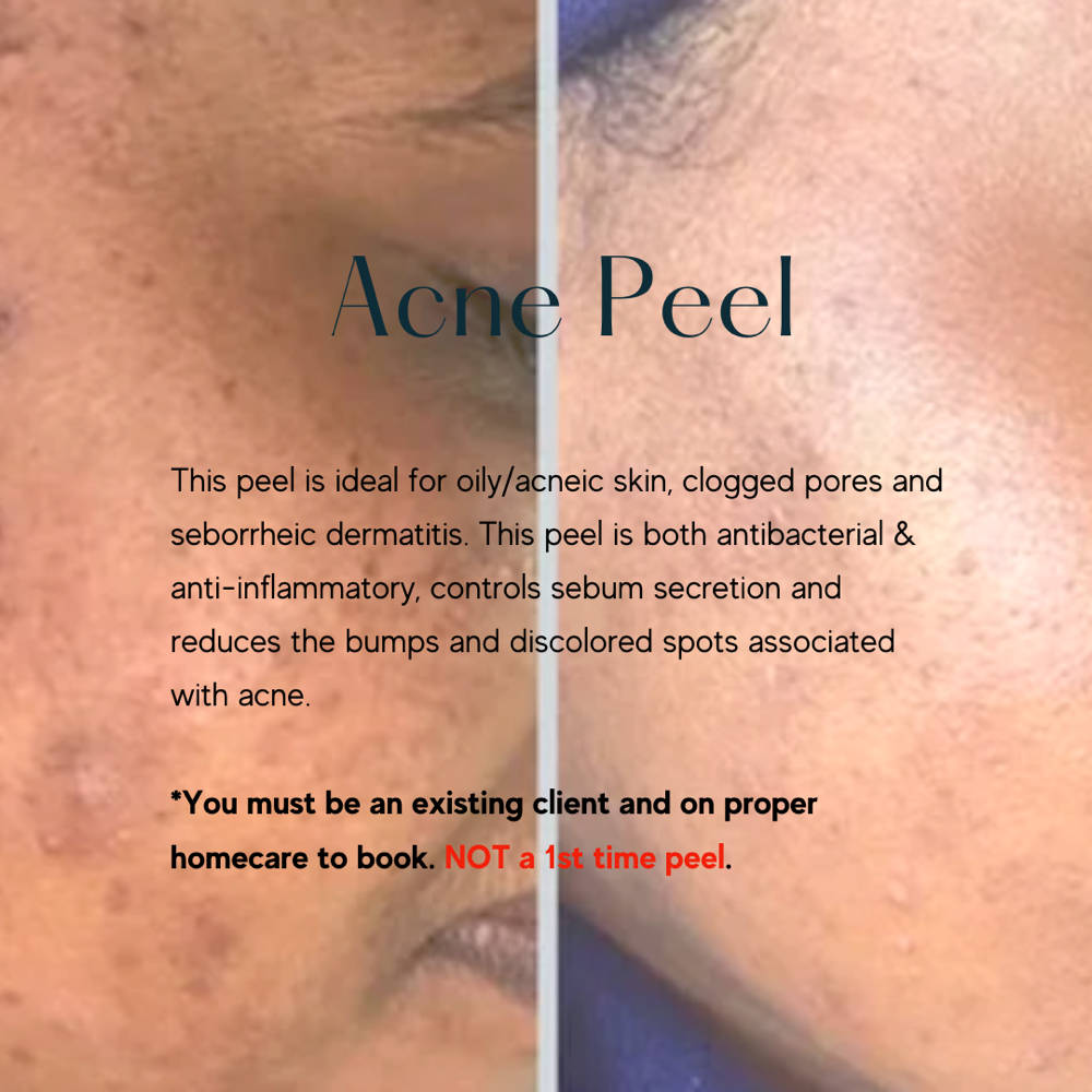 Acne Peel