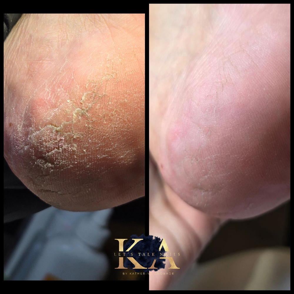Calluse Treatment