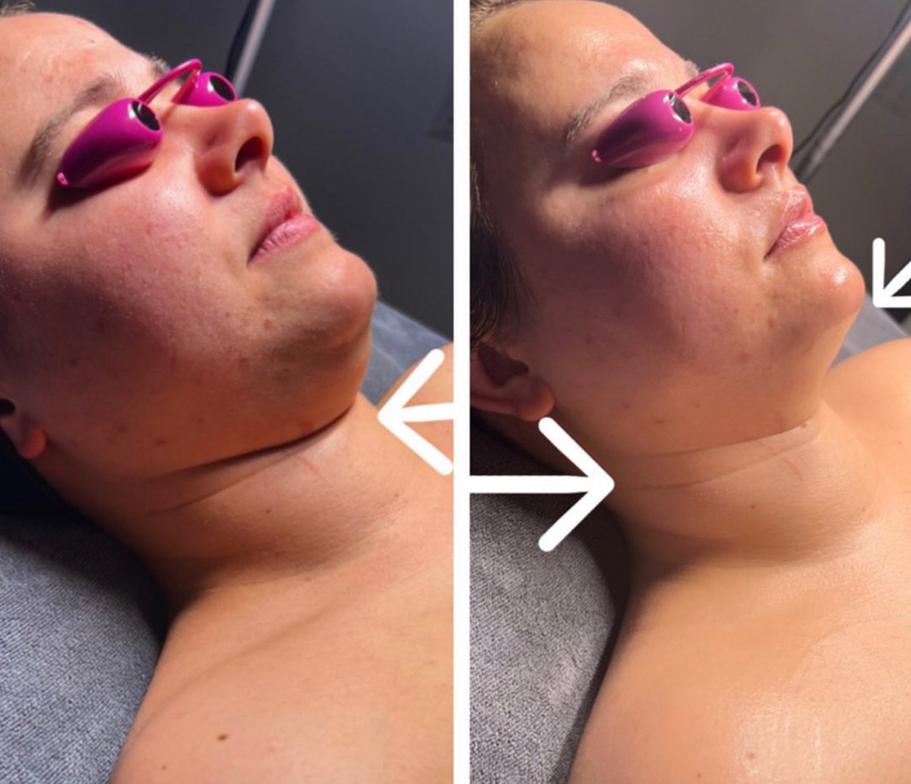 FACELIFT HYDRATION DRIP 90min