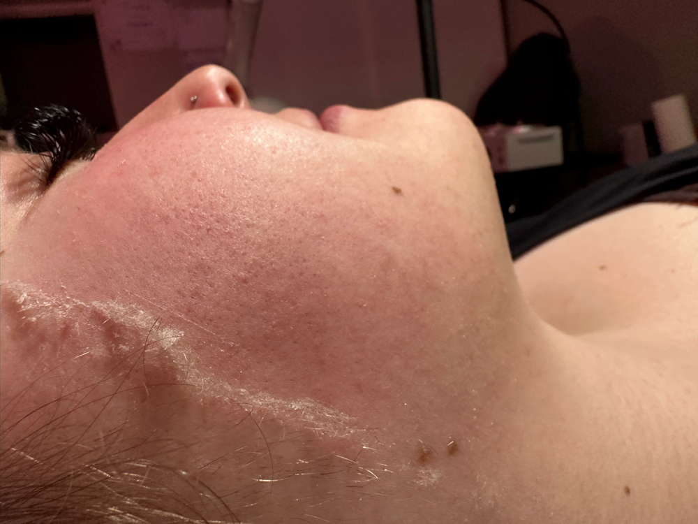 Dermaplane Add On