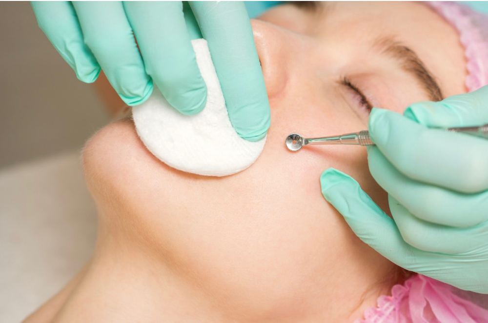 Acne Facial at kbesthetics in Jupiter, FL