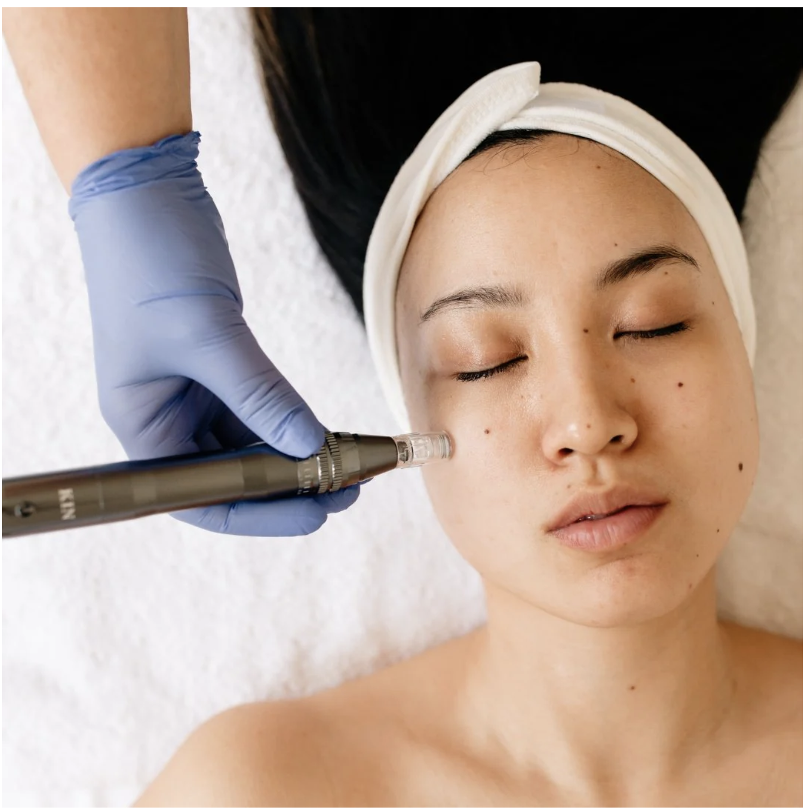Nano-Needling with KrX Meso Booster at Onyx Esthetics in Salem, OR