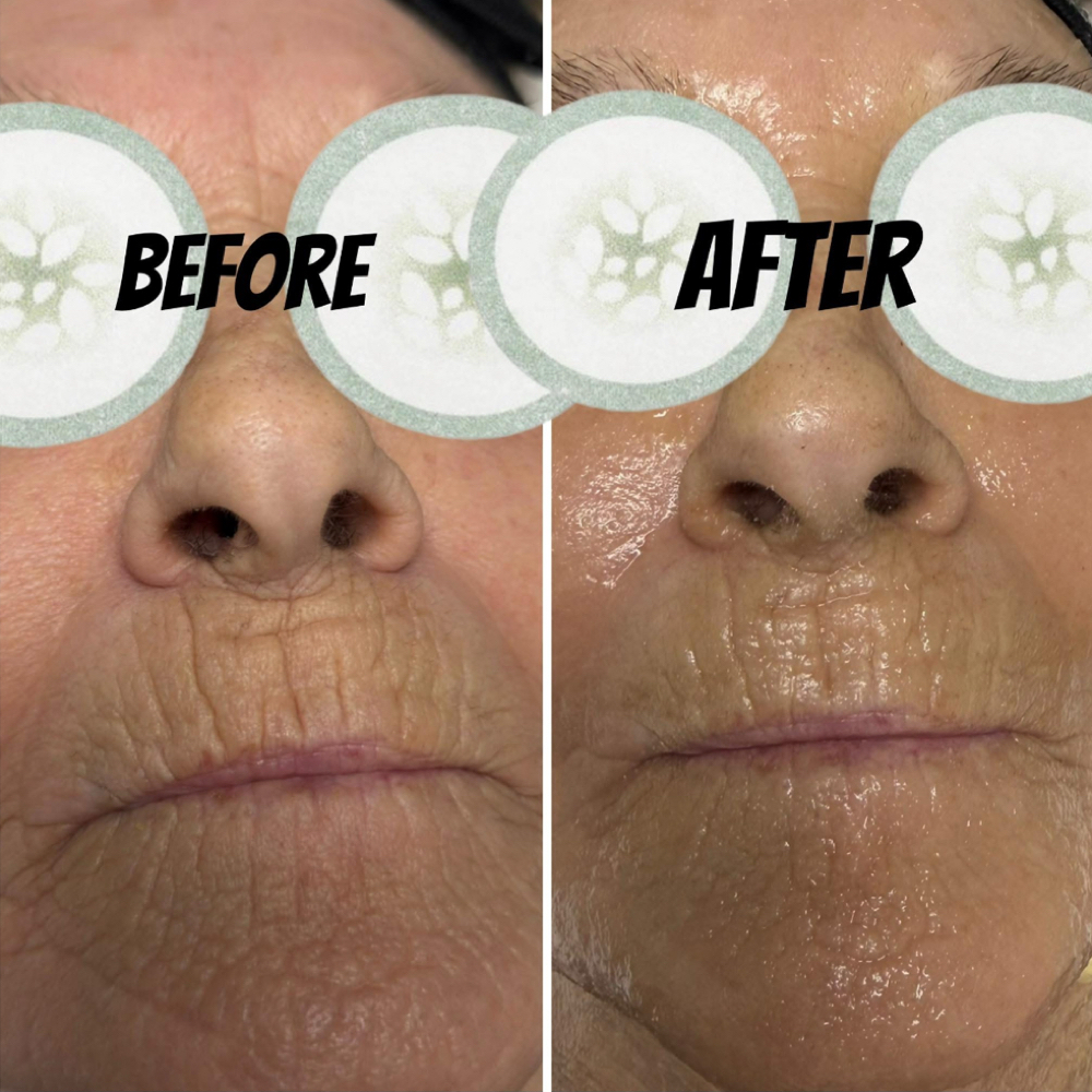Rezenerate Nano Infusion Treatment at Lashed Luxuries in Santa Clarita, CA