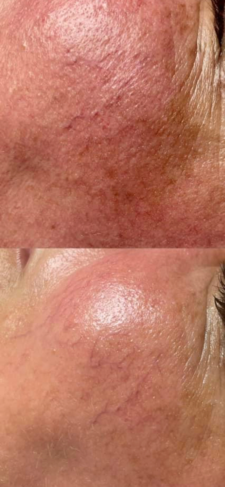 Rezenerate Nano Infusion Treatment