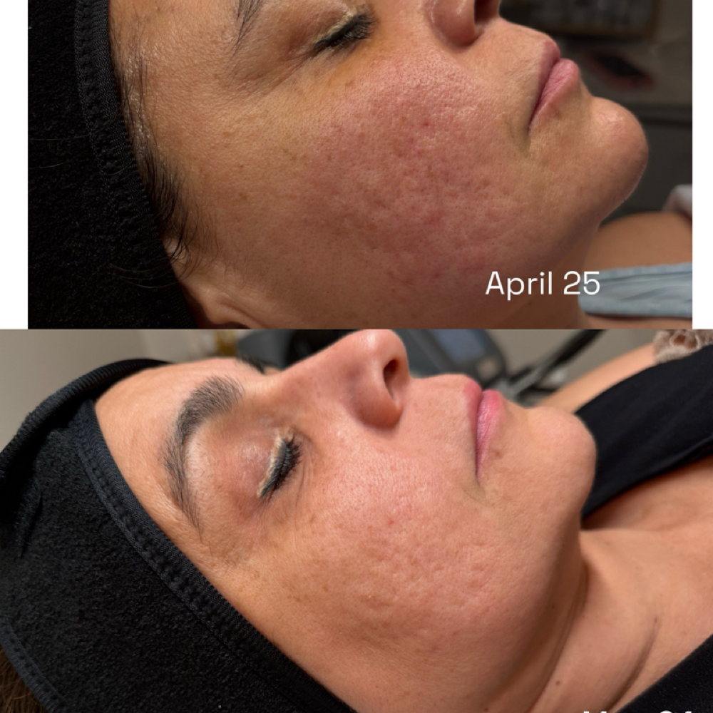 VENUS VIVA-SKIN RESURFACING at FACE2FACE SKIN STUDIO in Kew Gardens, NY