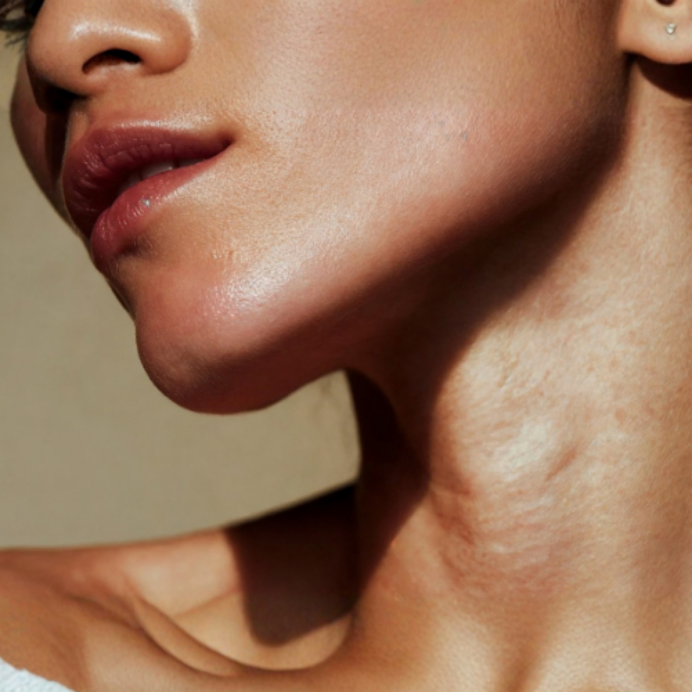 VENUS VIVA-SKIN RESURFACING at FACE2FACE SKIN STUDIO in Kew Gardens, NY