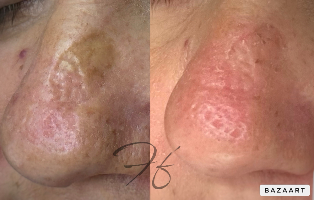 Scar Rejuvenation