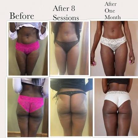 Cavitation Fat Reduction
