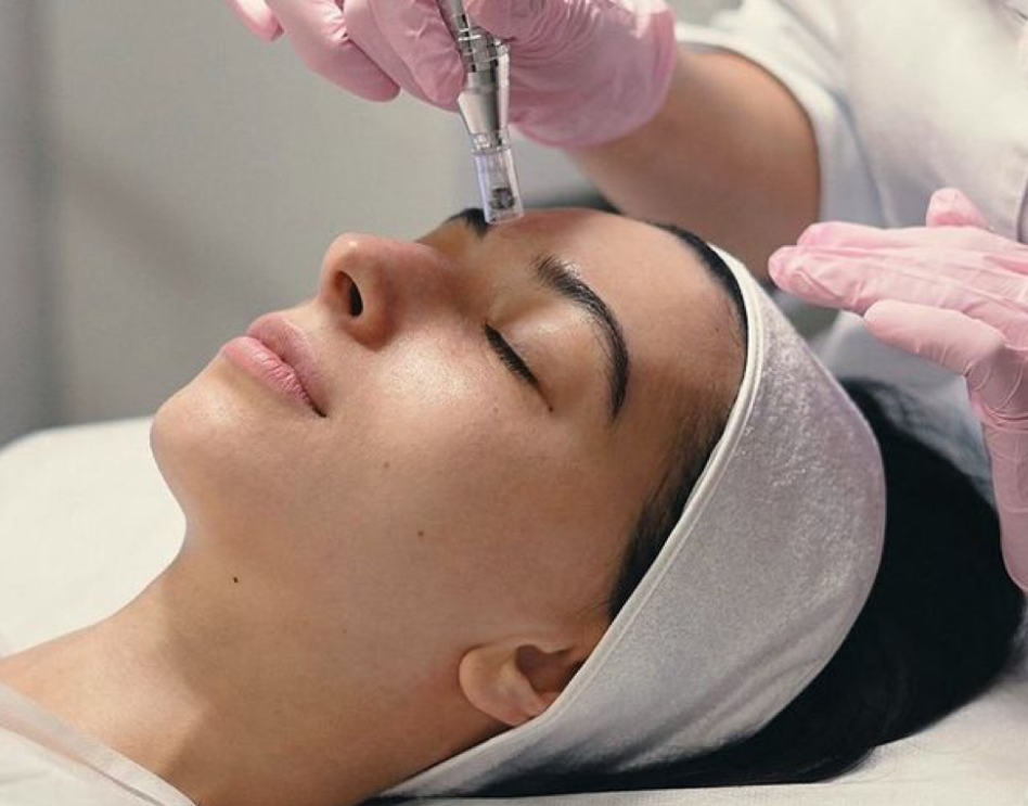 Microneedling Treatment Face