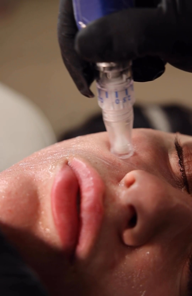 Skin Pen Elite Microneedling