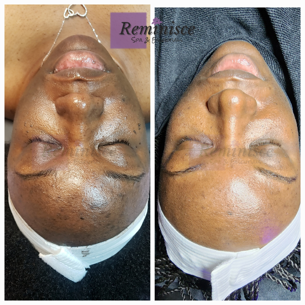 Chemical Peel