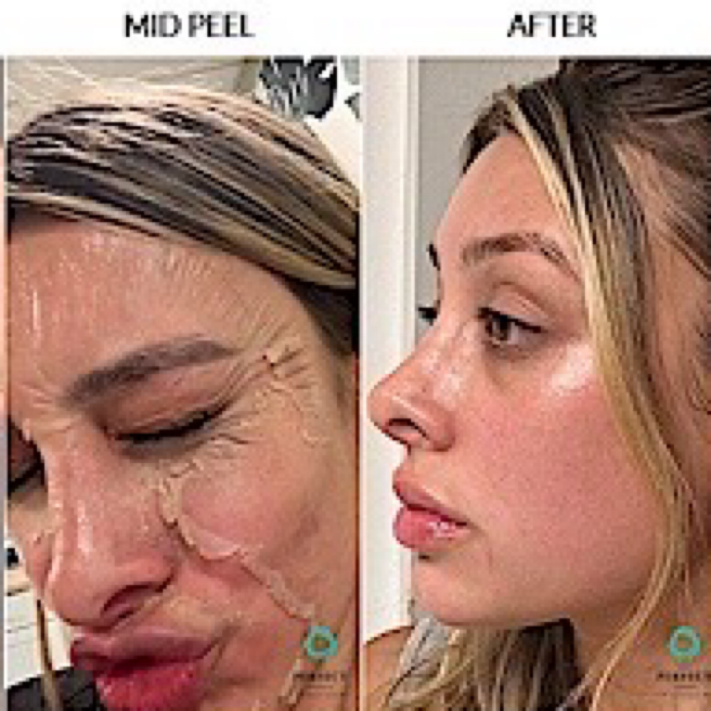 Perfect Derma Peel (Medical Grade) at Alt Boutique & Aesthetics | Nurse Injector in Hereford, TX