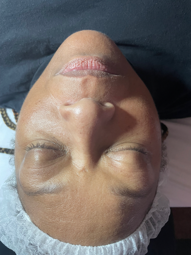 Dermaplaning With PCA Enzyme