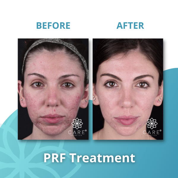 Facial Injections PRF X 3