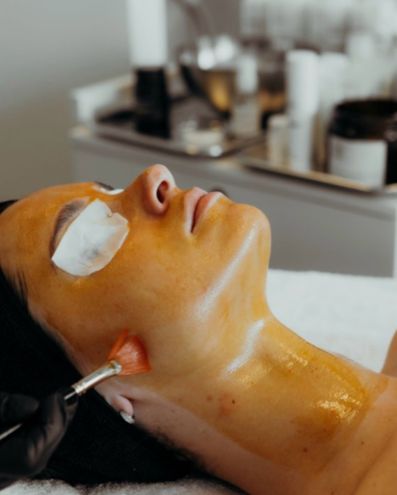 Chemical Peel