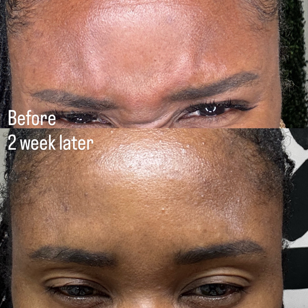 Botox(Xeomin) at Beauty Goals Medspa & Wellness in Frisco, TX