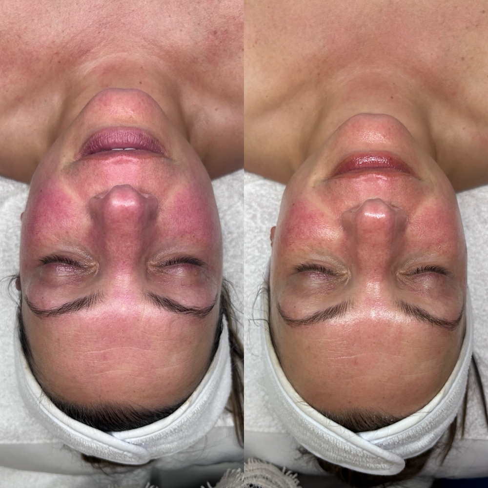 Oxygen Detox Facial