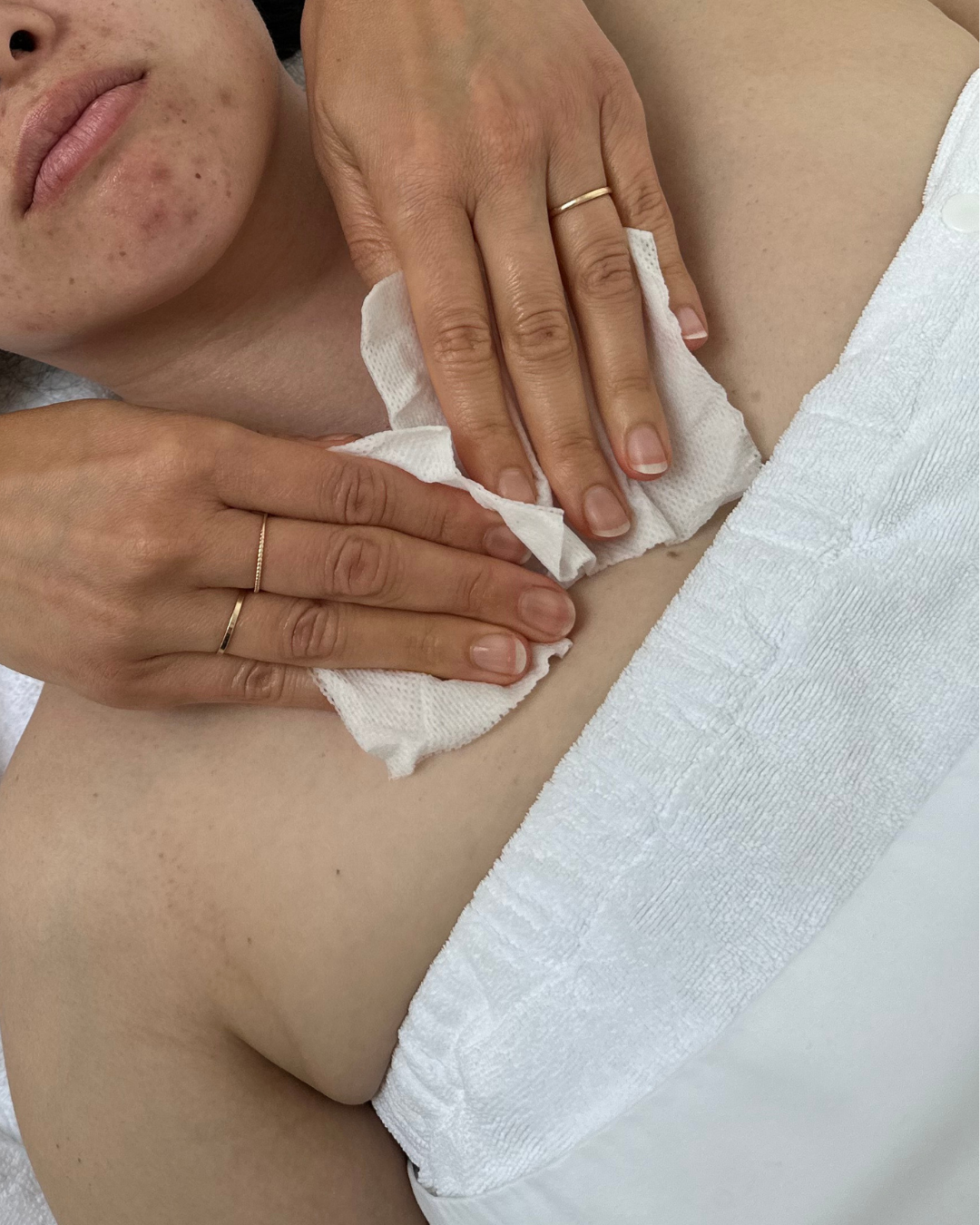 Acne + Blemish
