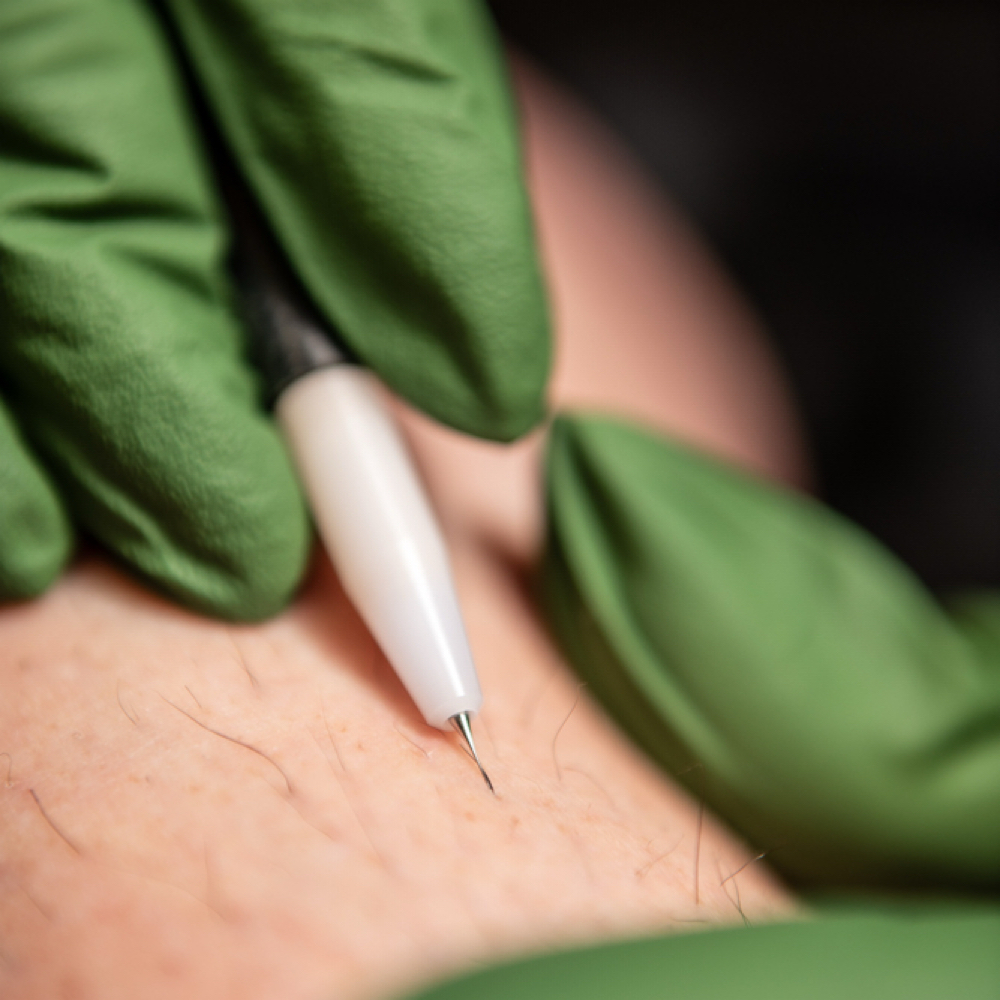 Electrolysis at Erika’s Beauty Secrets in Creedmoor, NC