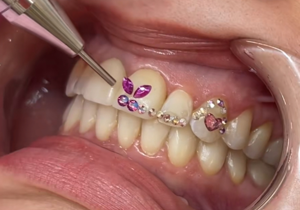 Tooth Gem