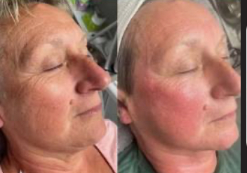 Collagen Introduction Facial