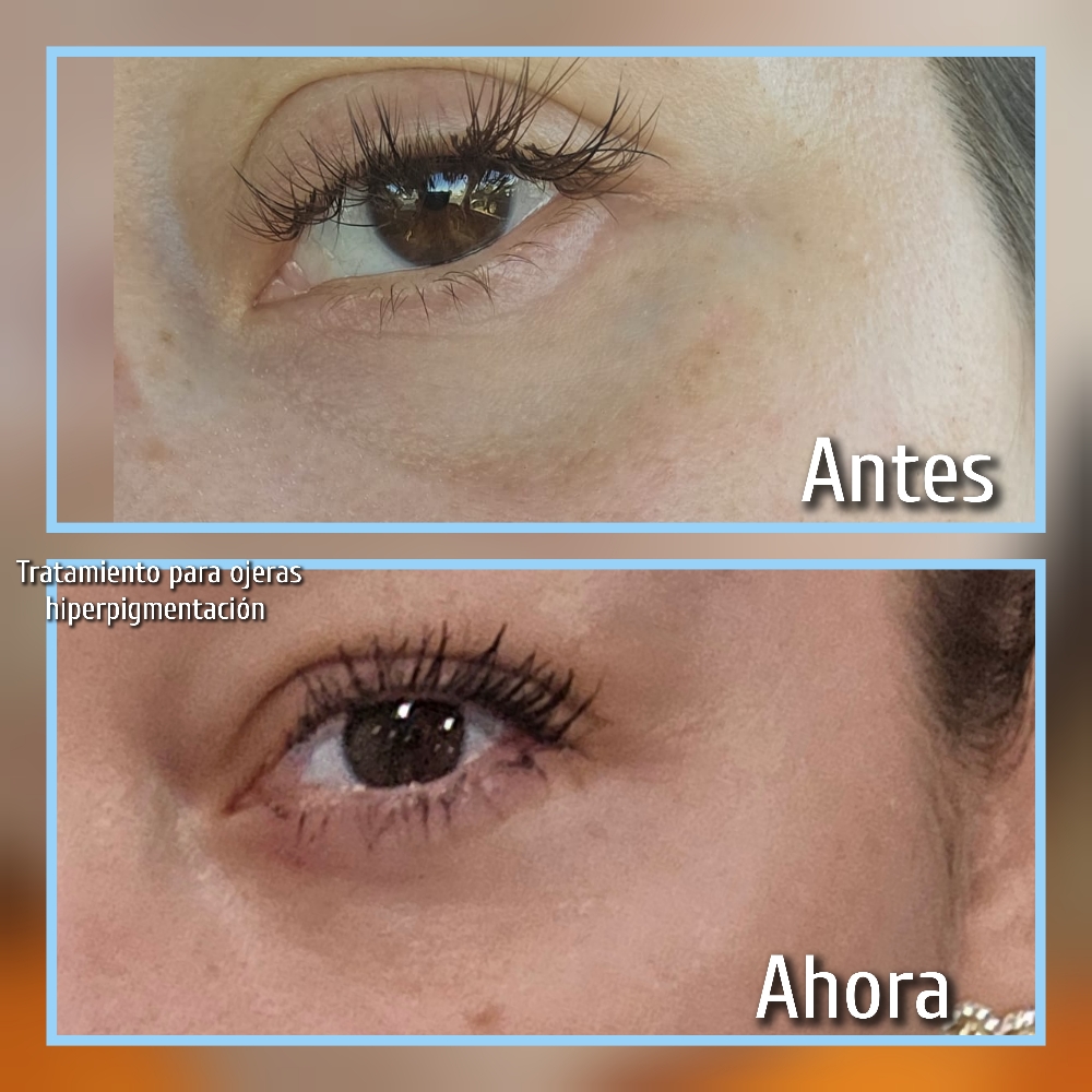Ojeras Con Bolsas Parpebrales