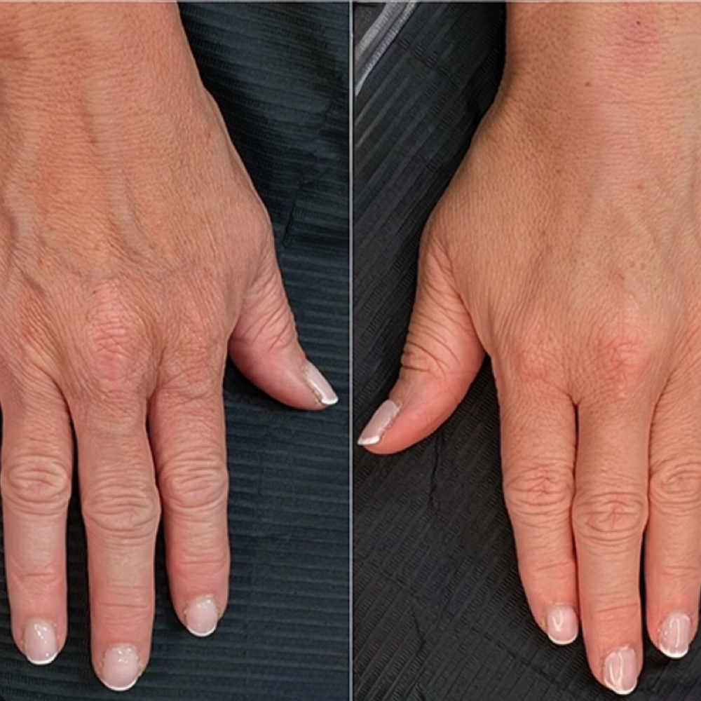 Prp hand rejuvenation at Reviva Wellness in Lake Ozark, MO