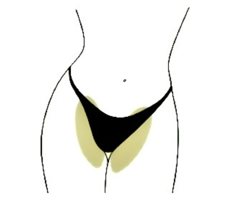 Modified Bikini(v)