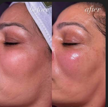 Oxygen Trio Infusion PCA Peel