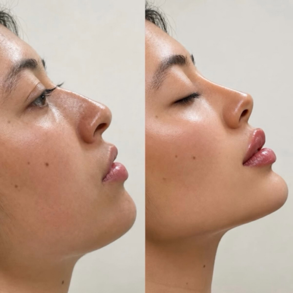 Chin Laser Lipo/Skin Tightening at Aesthetics by Amina in New York, NY