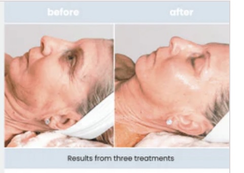 SWiCH Chemical Peel Alternative