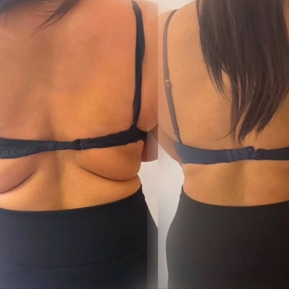 Fat Dissolving Injections