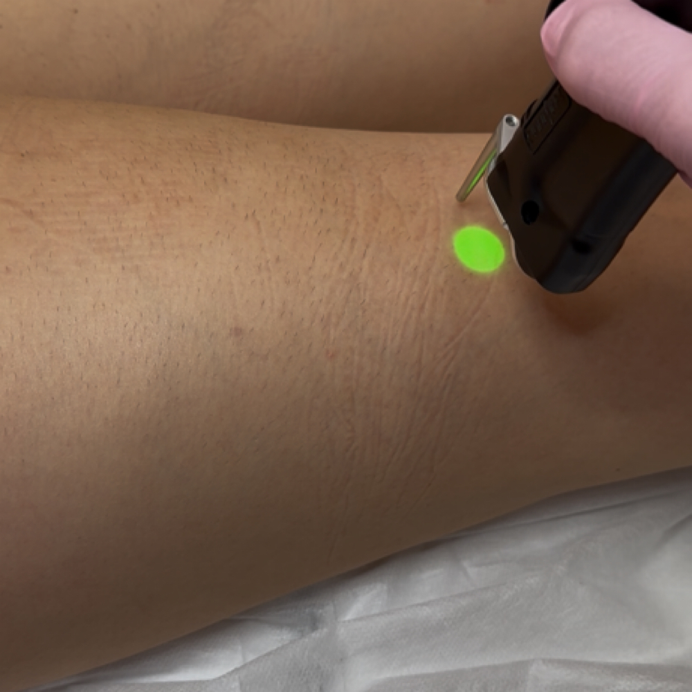 Laser Hair Removal- Thighs at Erika’s Beauty Lab in Littleton, CO