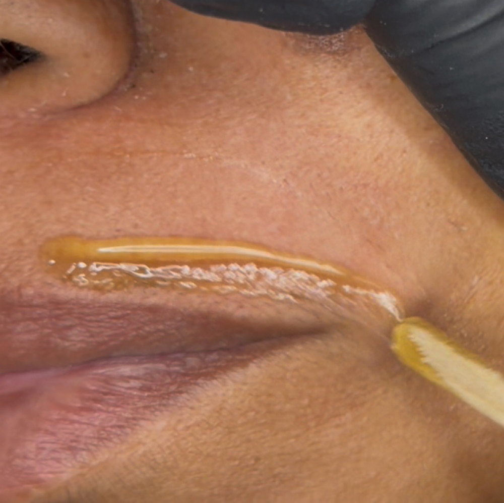 Upper Lip at Rich Care Esthetics in Winston Salem, NC