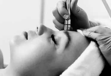 Diamond Microdermabrasion Facial