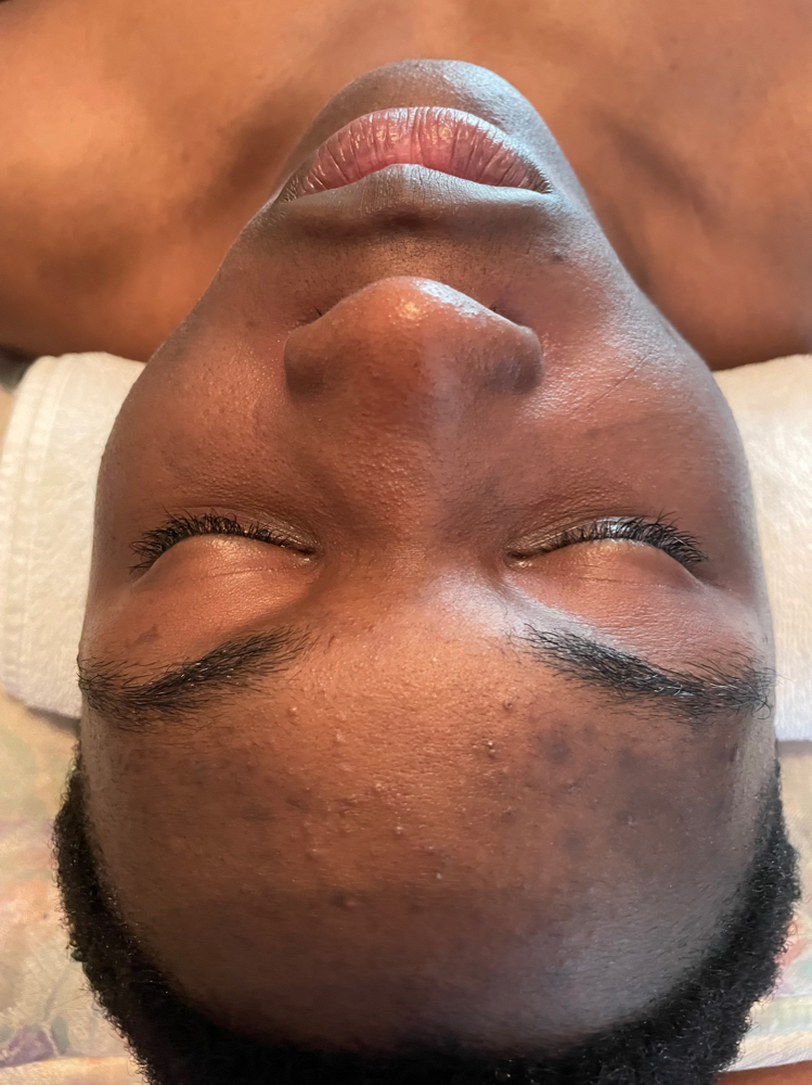 Oxygen Acne Facial