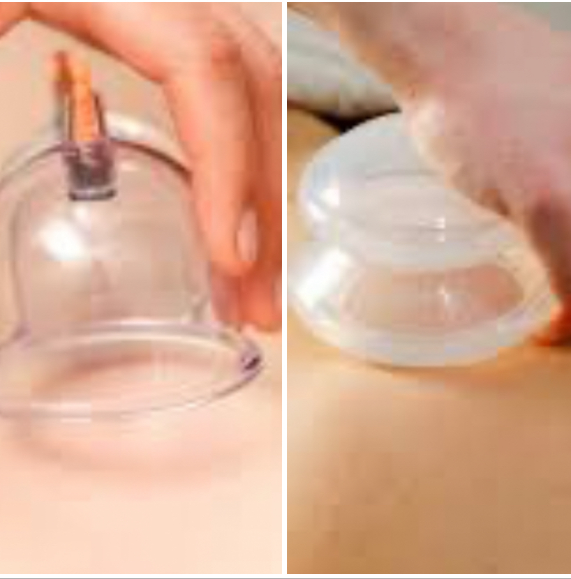 Cupping