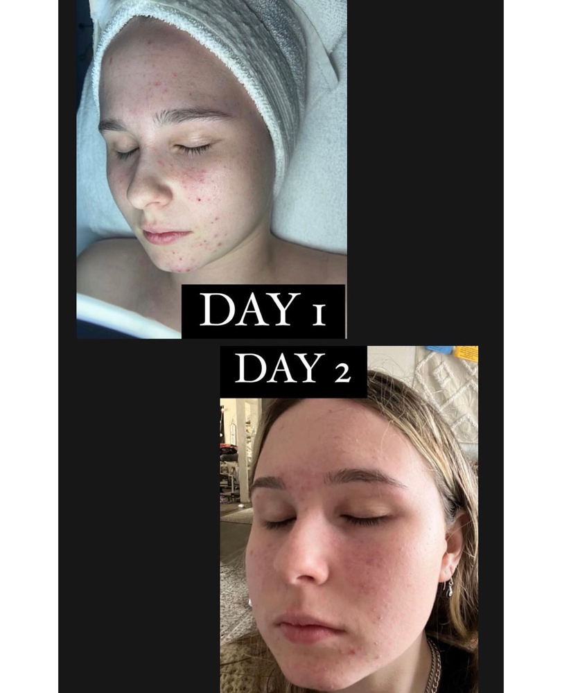 High Frequency Treatment