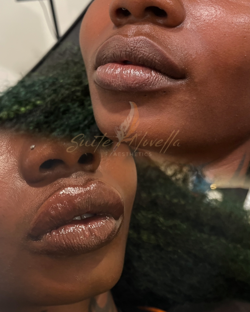 Lip Filler – Half Syringe (0.5mL)