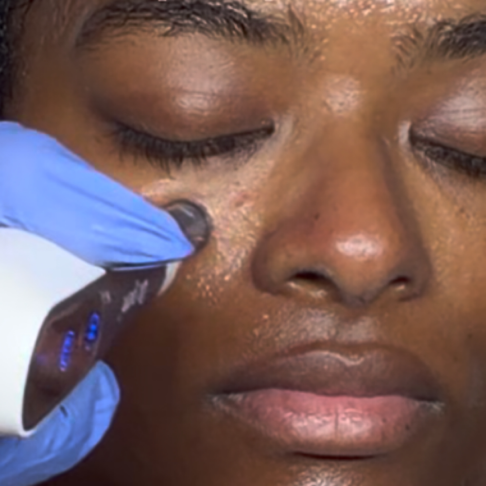 Nano- Infusion Facial at Radiant Eyes & Aesthetics in Petal, MS