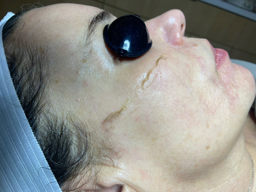 Dermaplaning Facial