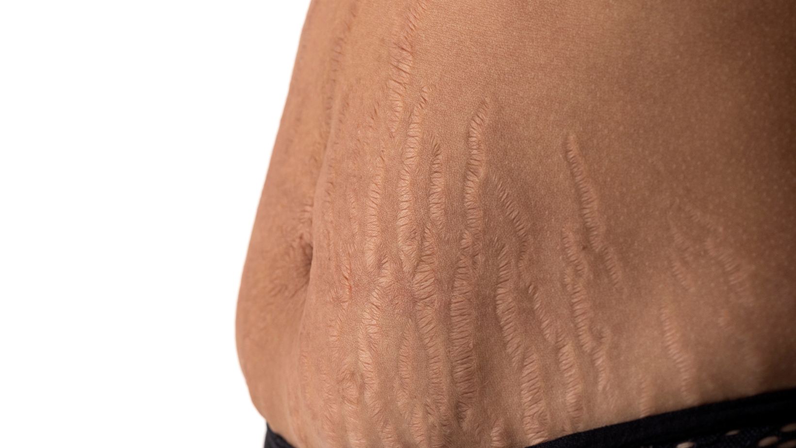 STRETCH MARKS RENEWAL SKIN