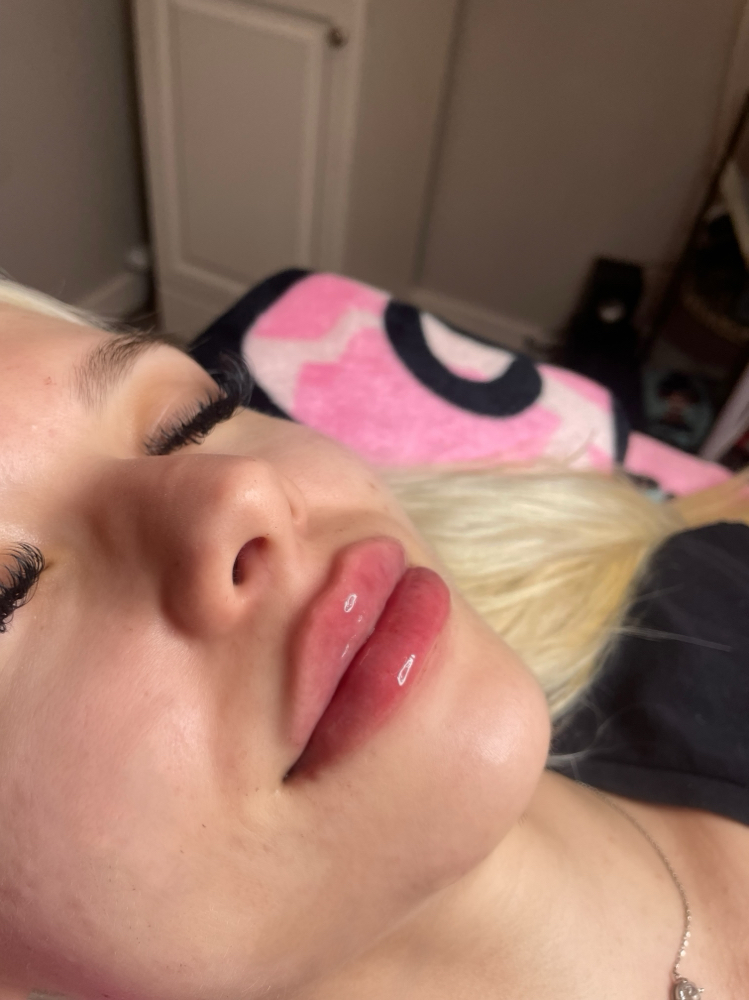 1ml of lip filler