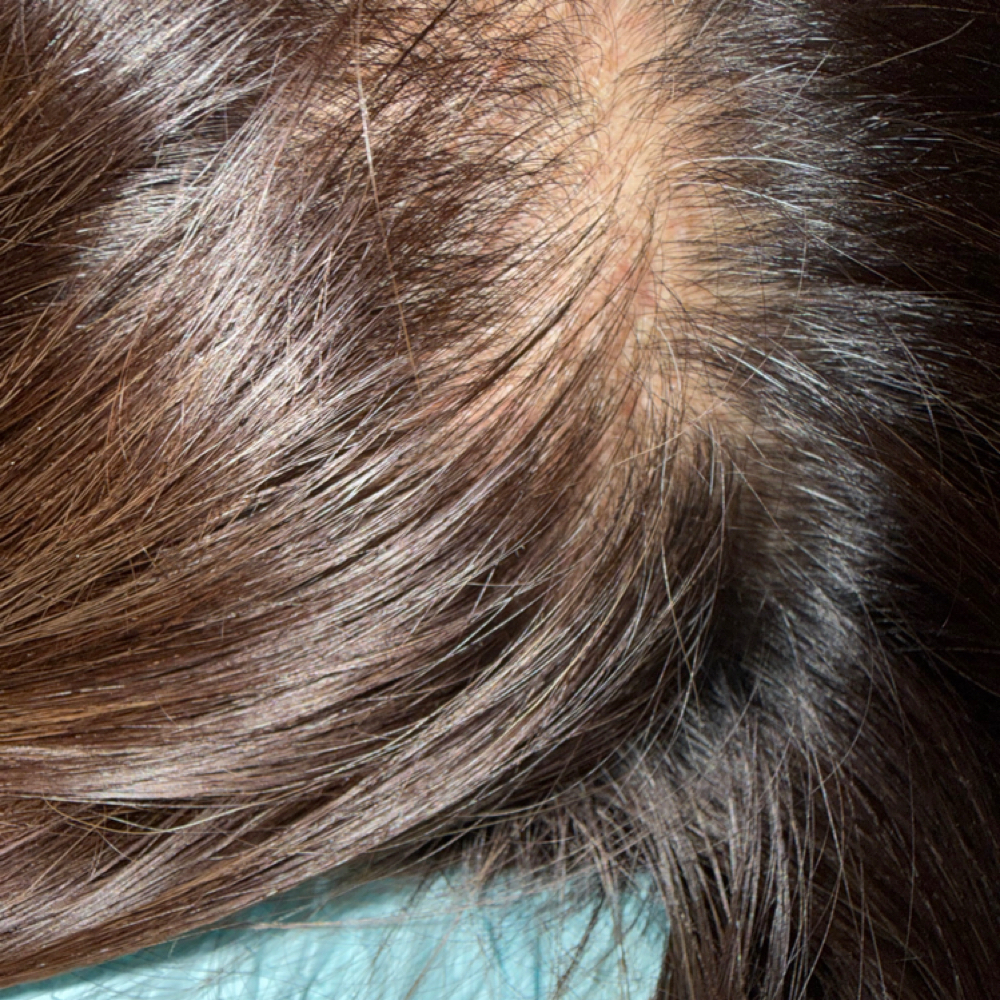 INTEGRITY© PRP/PRF Hair Restoration at Unmasked Aesthetics in Vancouver, WA