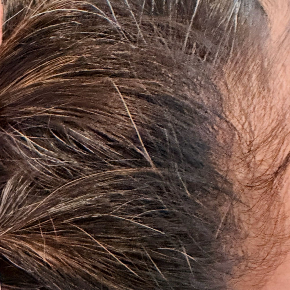 SkinStylus™PRP/PRF Hair Restoration at Unmasked Aesthetics in Clackamas, OR