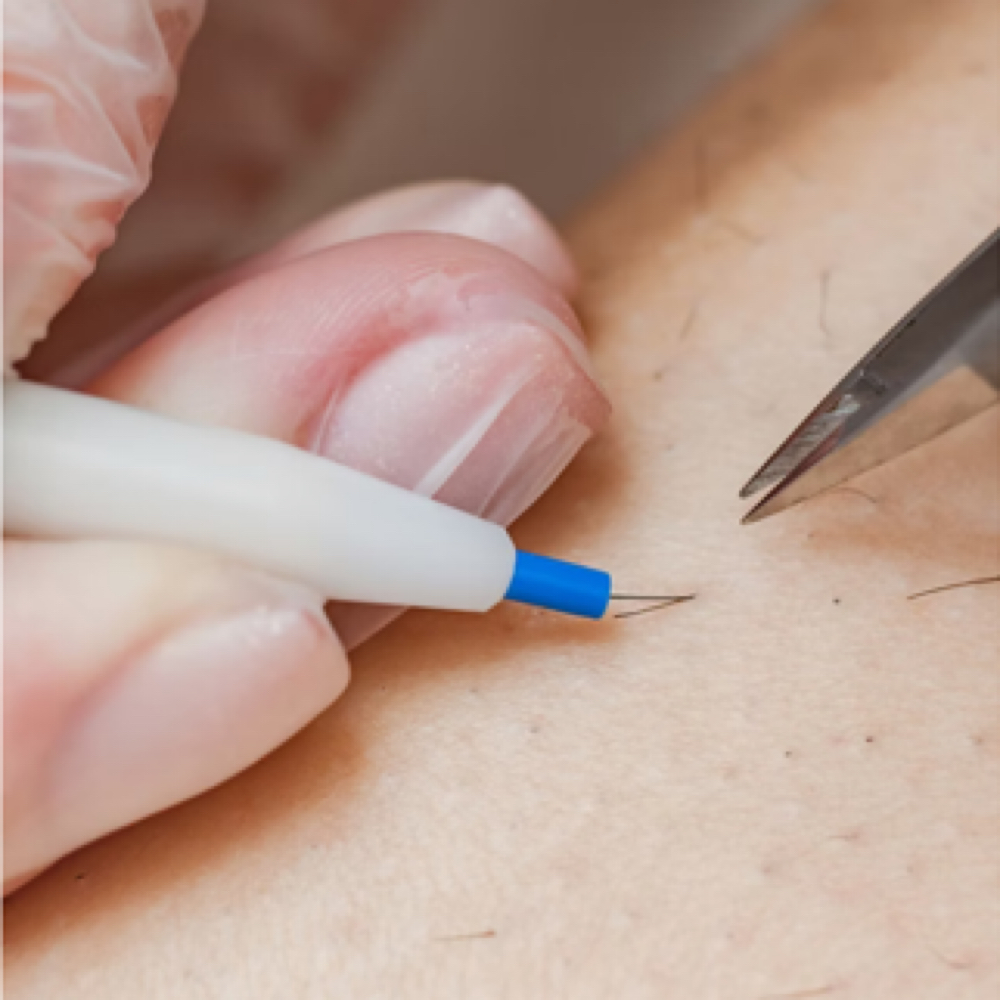 Electrolysis at Aura Electrolysis | Laser | Threading in Ashland, MA